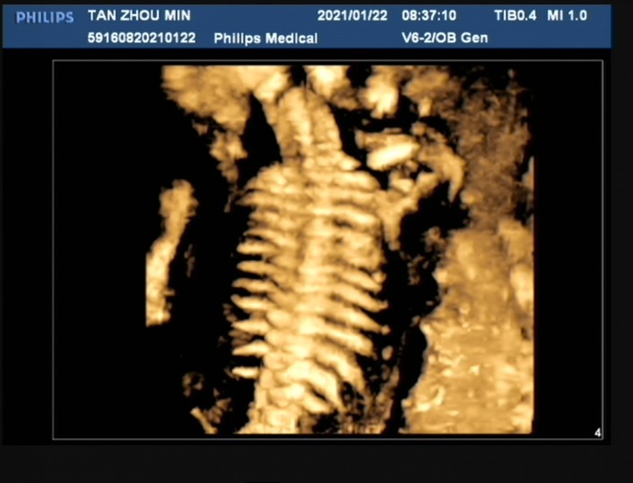 胎儿脊柱成像